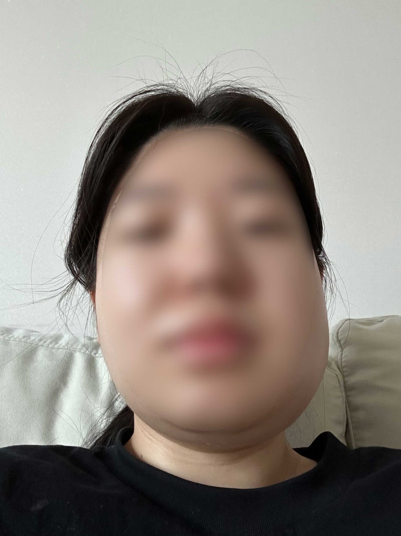 [사랑니 발치] 하루에 매복사랑니 2개 뽑고 네모빔 맞은 후기｜통증, 붓기, 사진공개