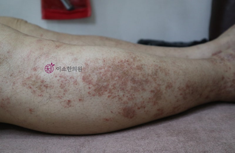색소성자반증, 습진? 피부염? NO! 연고 조심해야 하는 이유