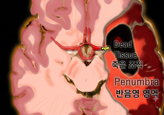 뇌경색 원인 전조 증상 초기증상 후유증 알고 대비하자