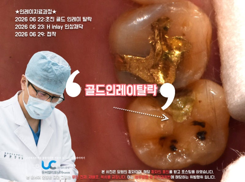 월곡동 치과 인레이가격 레진 세라믹 차이는?