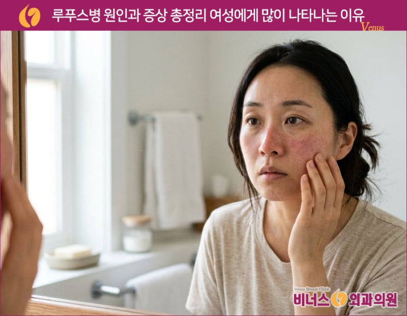 루푸스병 원인과 증상 총정리 여성에게 많이 나타나는 이유