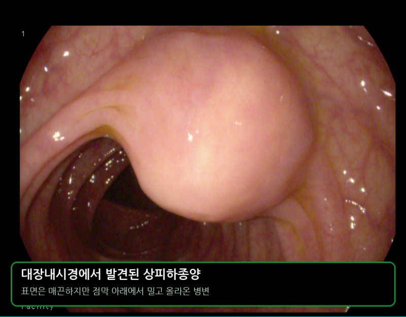 용종은 아니었지만 수술이 필요했던 대장 상피하종양
