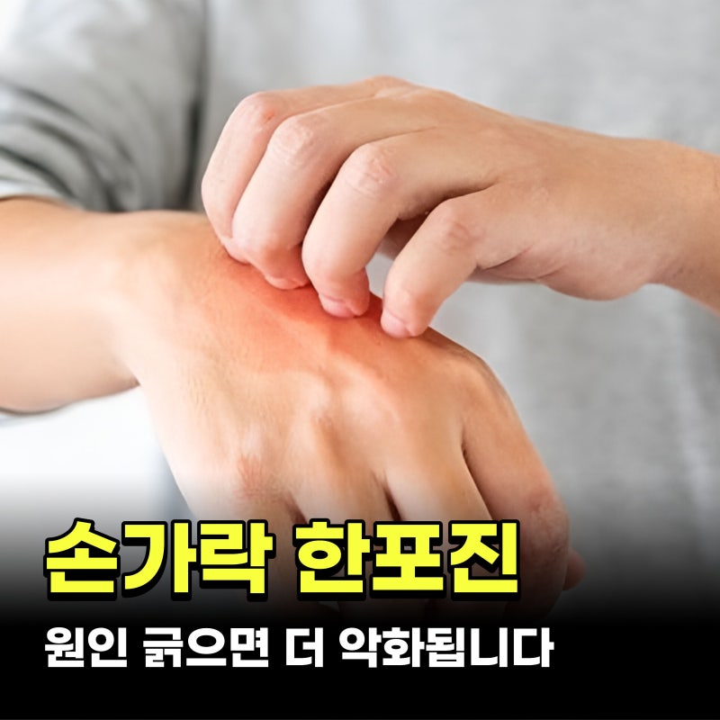 손가락 한포진 원인 4가지 긁으면 더 악화됩니다