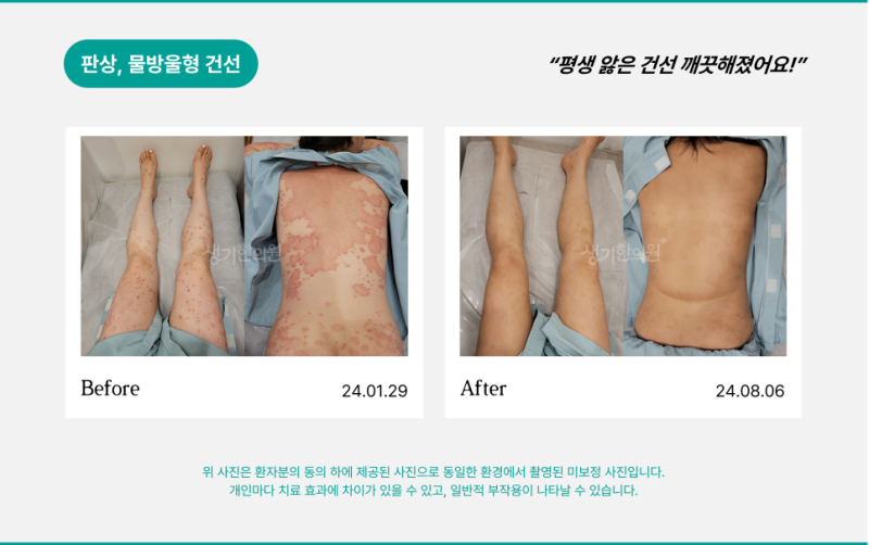 로션 발라도 안 낫는 팔꿈치 가려움, 건선 초기 증상일 수도 있습니다