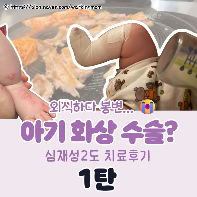 외식하다 봉변.. 5개월 아기 발 화상 치료기록, 대구 심재성 2도 수술 권유 통원치료 (1탄)