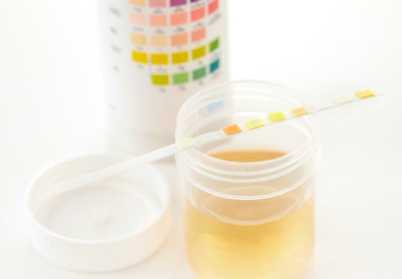 소변검사 5가지(5 types of urine tests)