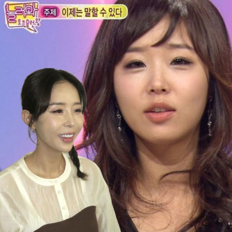 신지 양악수술 의혹 해명 '개구장애' 어색한 턱 입매 이유 있었네