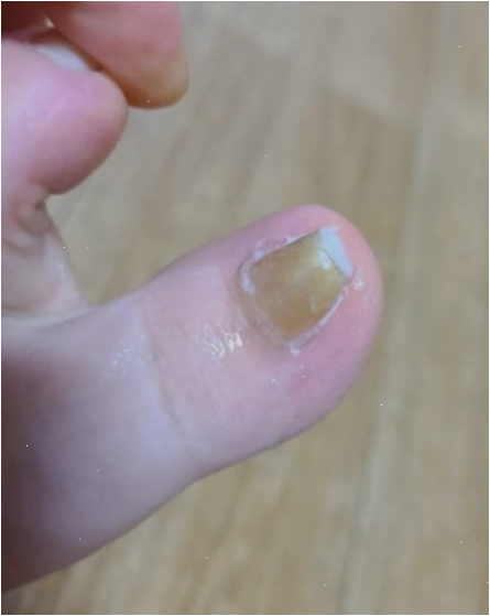 인버브무좀패치 붙여도 발톱 그대로던 날들