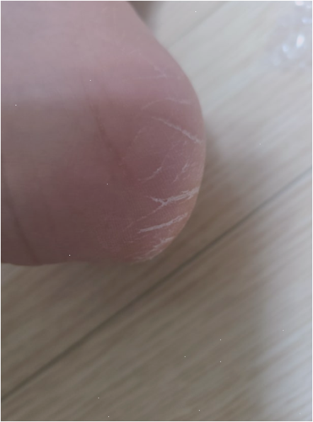 케라좀무좀약 발라도 발 못 내밀던 사람 모여라