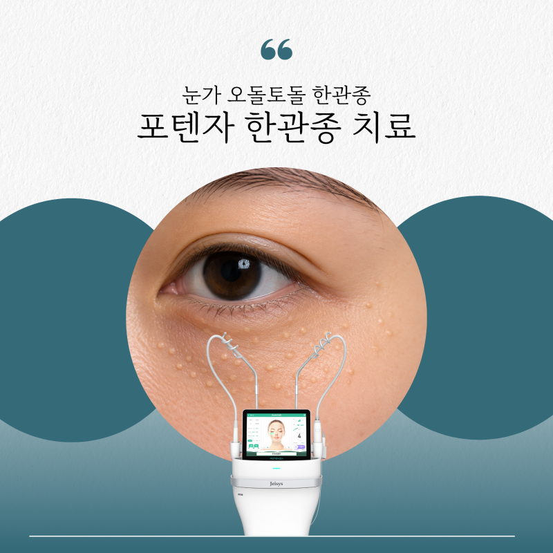 성북구 피부과 포텐자를 이용한 한관종 치료, 일반 레이저 치료와의 차이는?