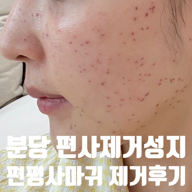 분당 편사 제거 성지: 편평사마귀 얼굴 제거 후기: 레이저 당일부터 2일 3일 7일 14일차 회복