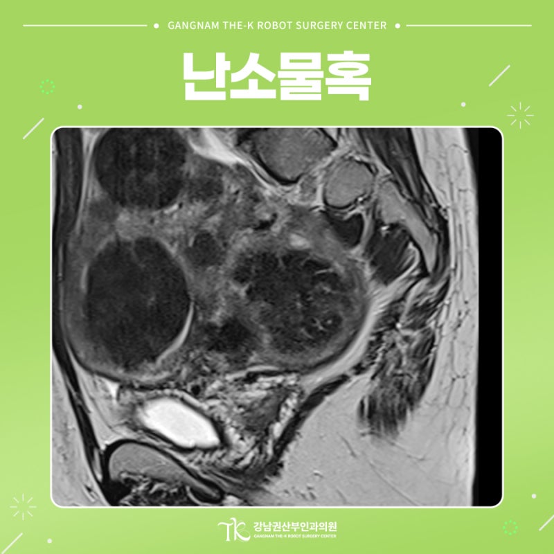 난소물혹 수술을 결정하게 되는 계기는?