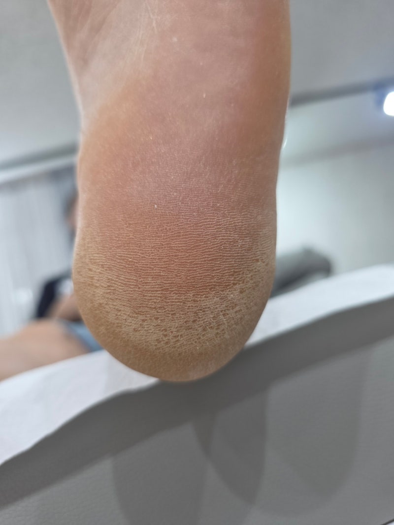발뒤꿈치 각질과 무좀의 차이점 정리, 각화형 무좀 증상과 올바른 제거 방법