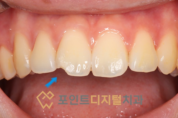 [탕정역치과] 티 안 나는 앞니파절 레진 치료, 외상의 흔적까지 지워야 완벽합니다 / 천안 아산