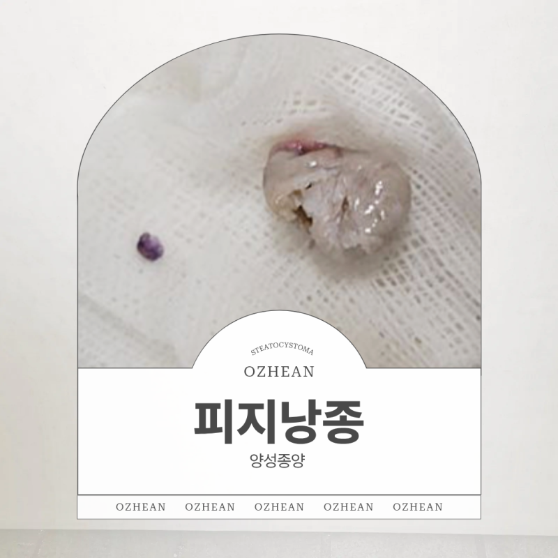 겨드랑이 피지낭종 반복되는 통증이라면 외과적 수술로 제거 치료해요
