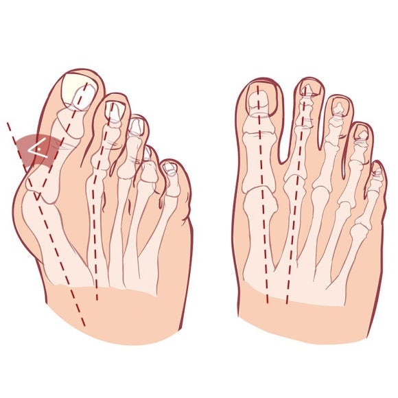 무지외반증 수술, 비용만 보고 결정하면 안되는 이유 [족부 전담 전문의 작성]