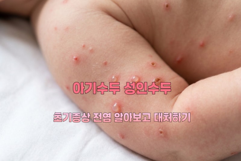 아기수두 성인수두 초기증상 전염 알아보고 대처하기