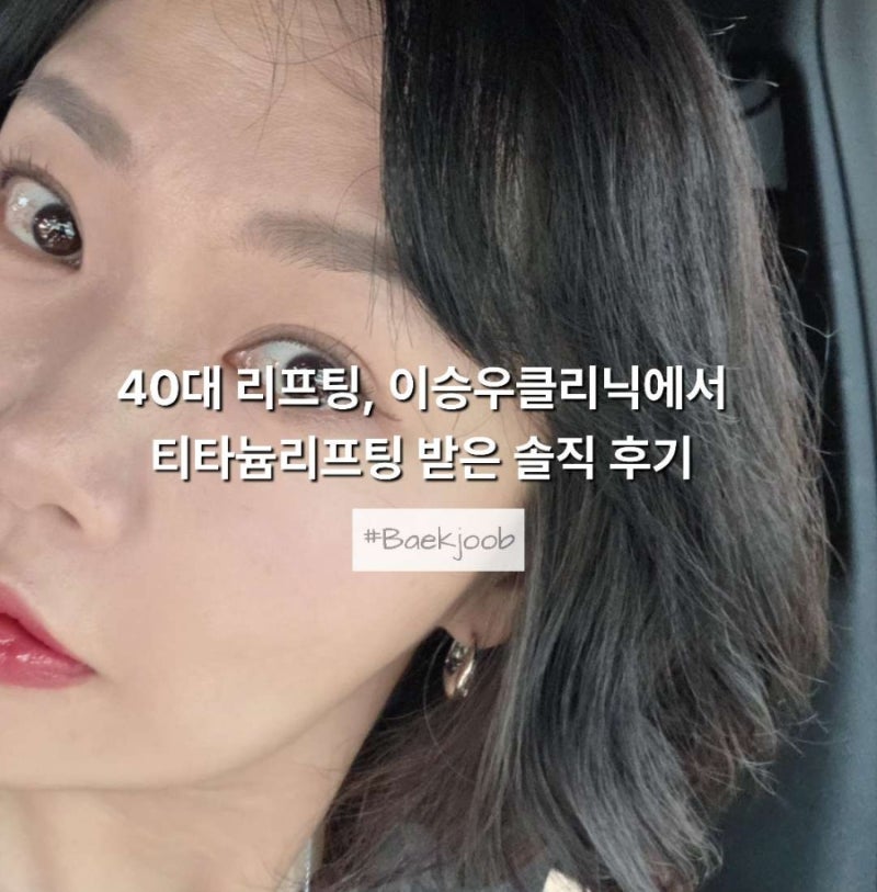 40대 리프팅, 이승우클리닉에서 티타늄리프팅 받은 솔직 후기