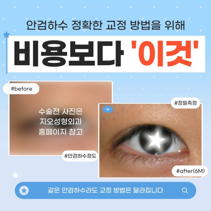 안검하수 비용, 저교정 생기면 2배로 증가?