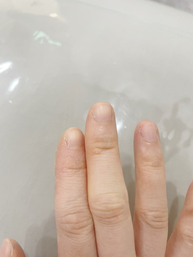 손가락 사마귀 제거(냉동치료 방법, 비용)