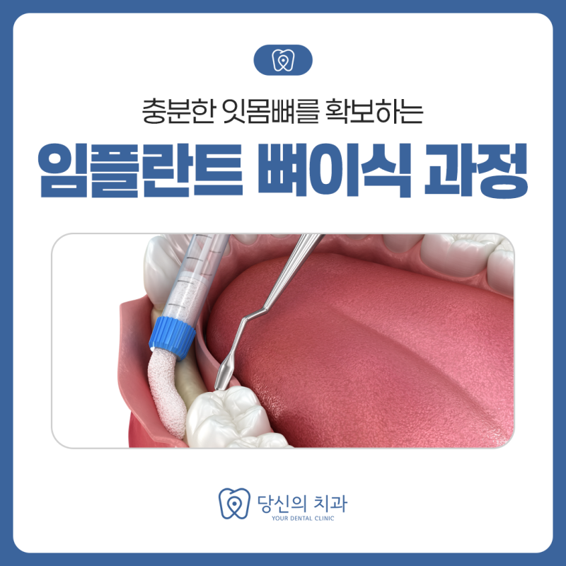안양호계동치과 임플란트 뼈이식 과정, 잇몸뼈 보강은 어떻게 진행될까?