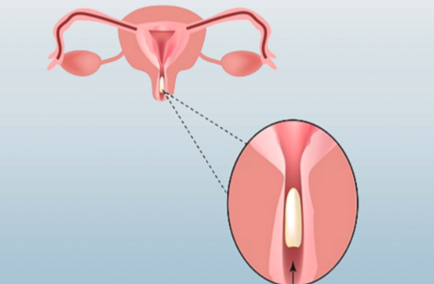 칸디다 질염약 카네스텐 연고 질정 뭐가 효과 좋을까? 손쉽게 연고 바르고 질정 넣는 방법 까....