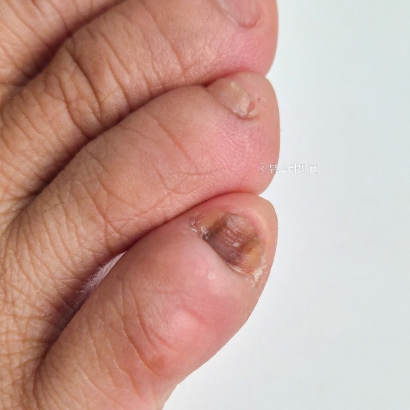 인천발톱무좀병원 송도레이저치료 후기 변색, 두꺼워짐 고민