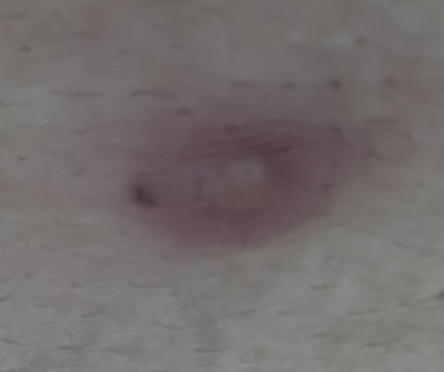 여자 생식기 피지낭종을 예방하는 방법은?특징과 원인부터 제거 후 관리 방법까지