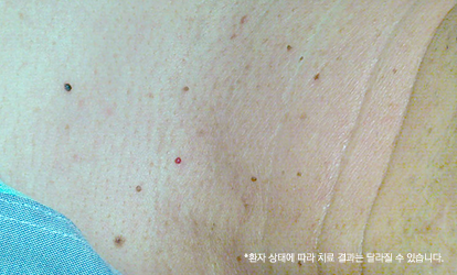 편평사마귀 원인 바이러스 제거와 레이저 치료