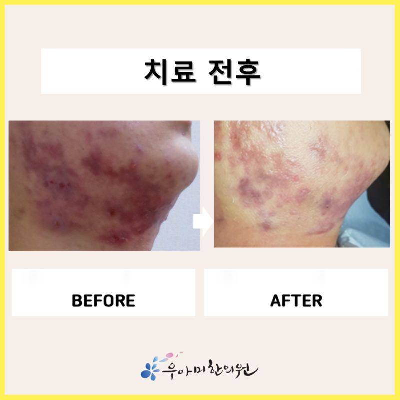 결절성 양진 치료, 피부에 남은 흔적부터 읽어야 합니다