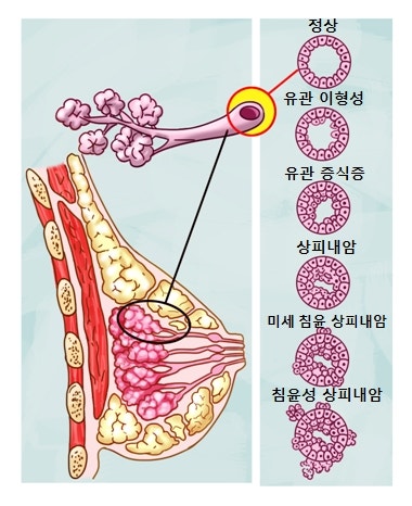 건강검진에서 '판정 유보', 4개월 뒤 유방 제자리암 진단