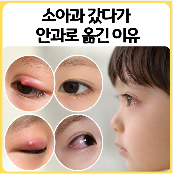 아기 눈병 | 눈곱·충혈·다래끼·안검염·결막염 가려내는 법