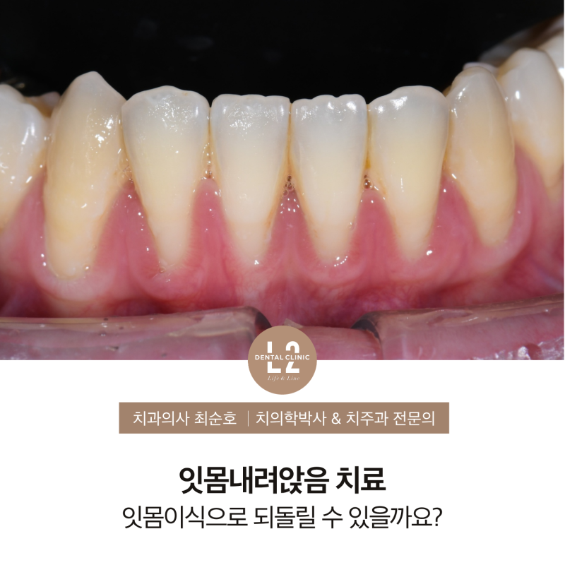 잇몸내려앉음 치료, 잇몸이식으로 되돌릴 수 있을까요?