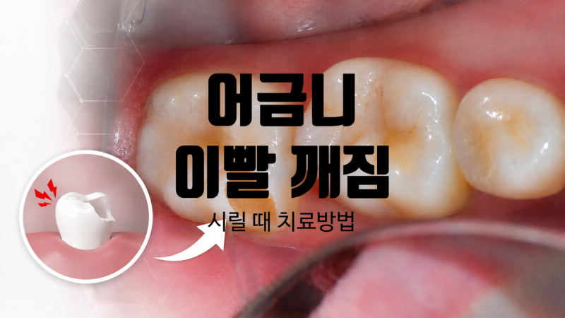 충정로치과 어금니 깨짐, 이빨 시릴 때 크라운이 필요할까?