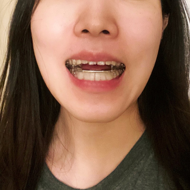 비수술 주걱턱 교정 비용 현실 후기