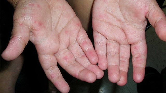 수족구 초기증상 총정리ㅣ전염·잠복기·격리 기간부터 어른 수족구까지