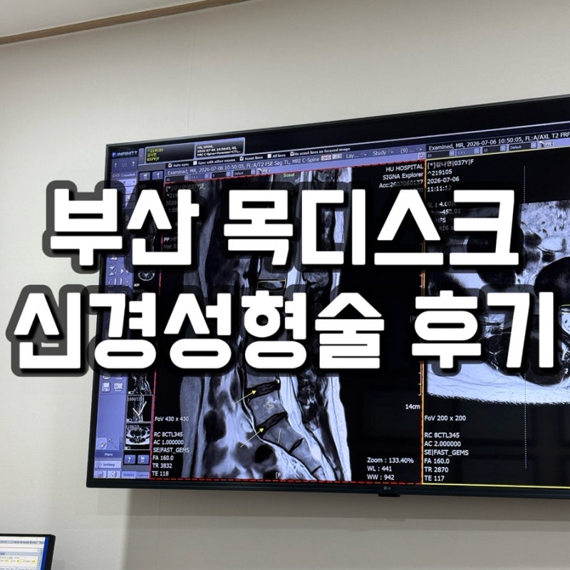 부산 목디스크 신경성형술 후기 - 병원을 잘 못 고른걸까?