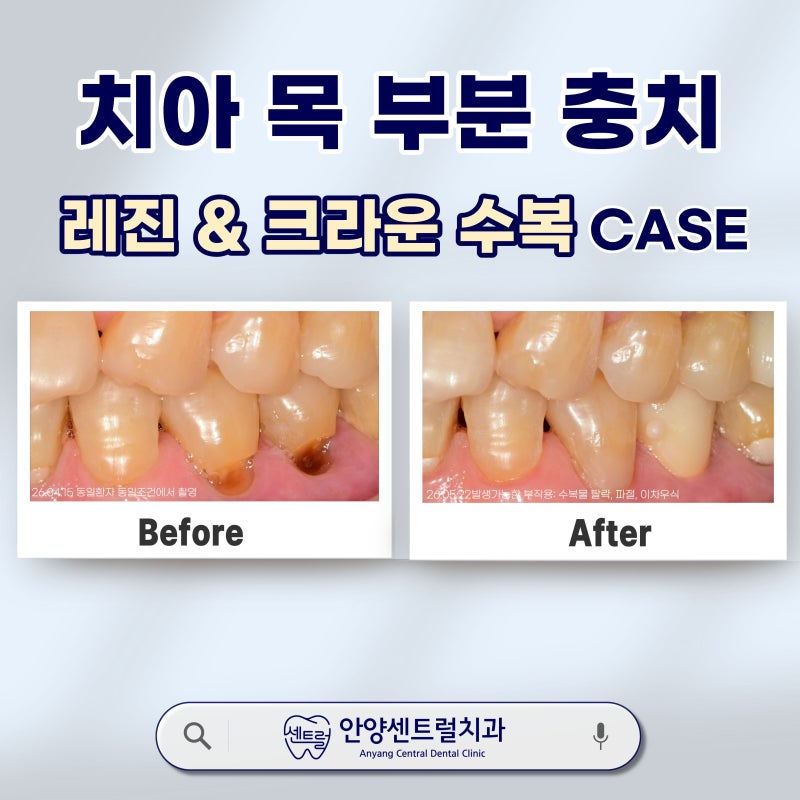 안양치과 치아 목부분 패임, 레진과 신경치료의 결정적 갈림길