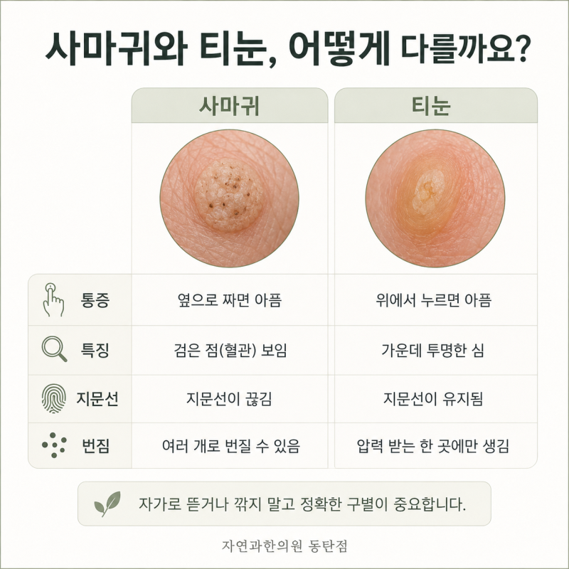 사마귀, 왜 생기고 어떻게 없애나요? | 종류·원인·치료 방향 총정리