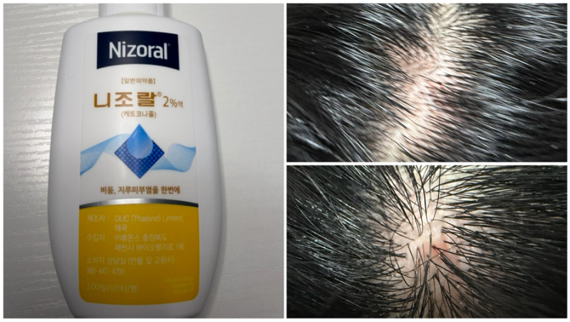 니조랄샴푸 지루성두피염 약국용가격 내돈내산 사용후기 (효과 제대로 보는 사용법)