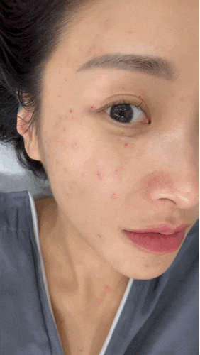 명동편평사마귀 무한제거 후기- 수기복합 회복기간