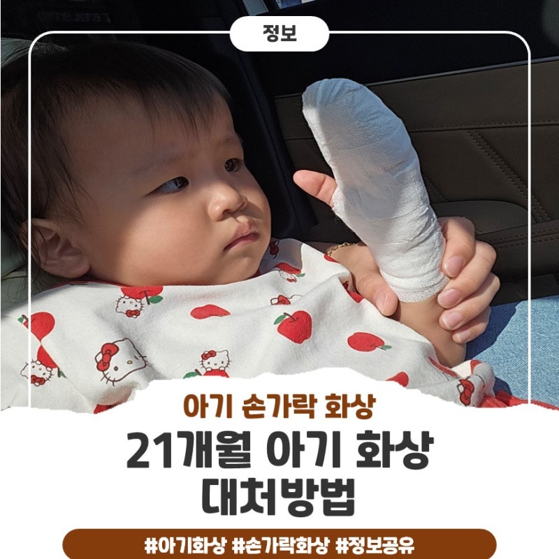21개월 아기 손가락 화상 경험하며 알게 된 대처법