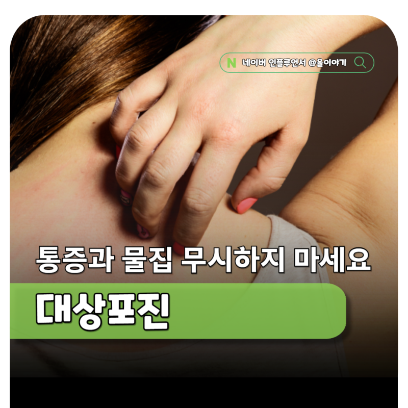 임산부 대상포진 초기 증상, 통증과 물집 그냥 넘기지 마세요