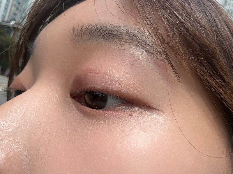 콩다래끼 째기 고통후기 생각보다 금방 끝나긴 했는데..