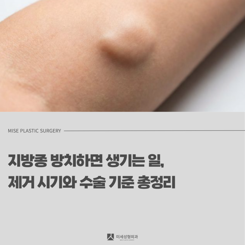 수원 광교 동탄 오산 지방종 방치하면 생기는 일, 제거 시기와 수술 기준 총정리