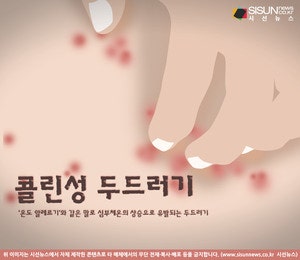 음식 때문이 아니다? 물리적 자극이 만드는 두드러기: 피부묘기증과 한랭·콜린성 두드러기 ....