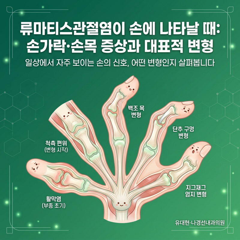서초구 류마티스관절염이 손에 나타날 때: 손가락·손목 증상과 변형 총정리