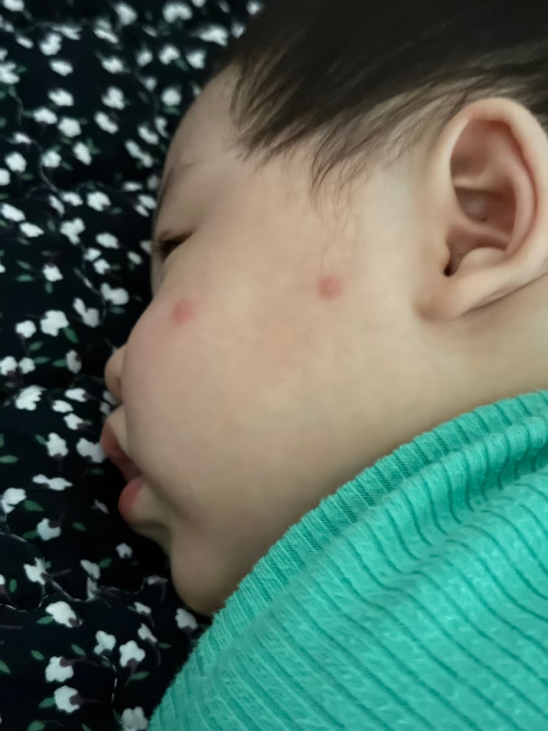 [아기가 아파요] 8개월 아기 구진성 두드러기, 처음엔 수족구인 줄 알았어요. (증상·병원 진....