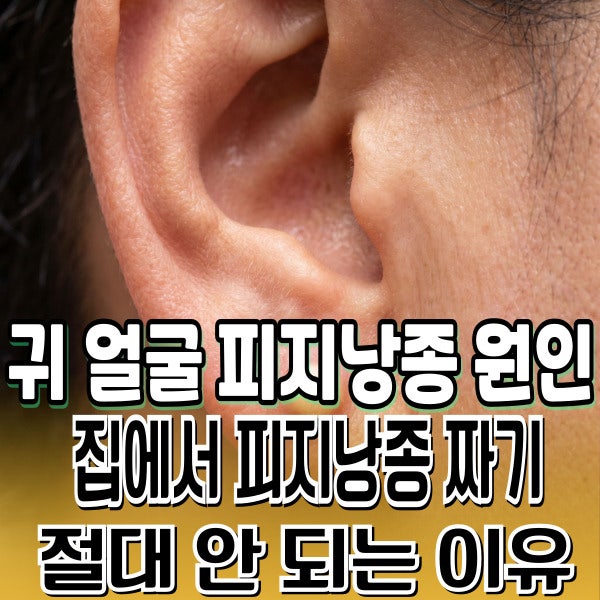 귀 얼굴 피지낭종 원인 및 집에서 피지낭종 짜기 절대 안 되는 이유