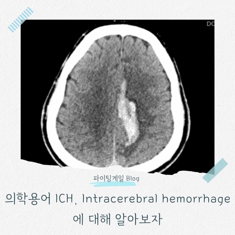 의학용어 ICH, Intracerebral hemorrhage에 대해 알아보자